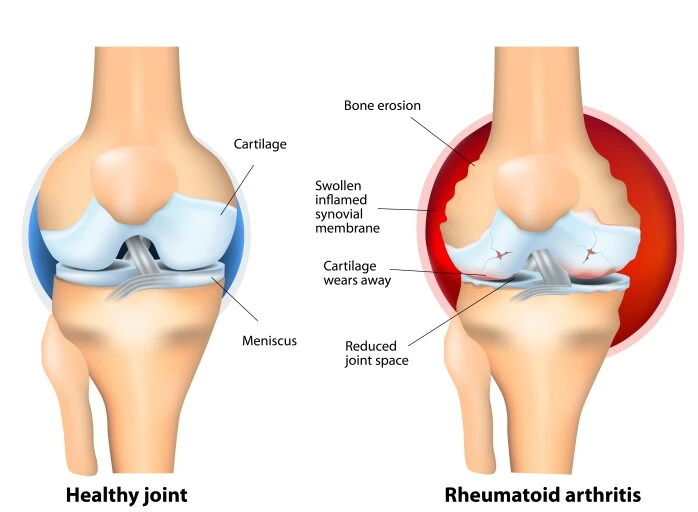 Cartilage gets more damaged